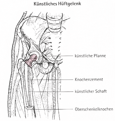 Rheuma, mehr als hundert verschiedene Krankheitsformen