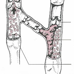 Oberflächliche Venenentzündung (Phlebitis)