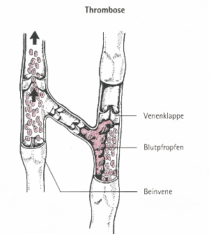 Tiefe Venenentzündung 1